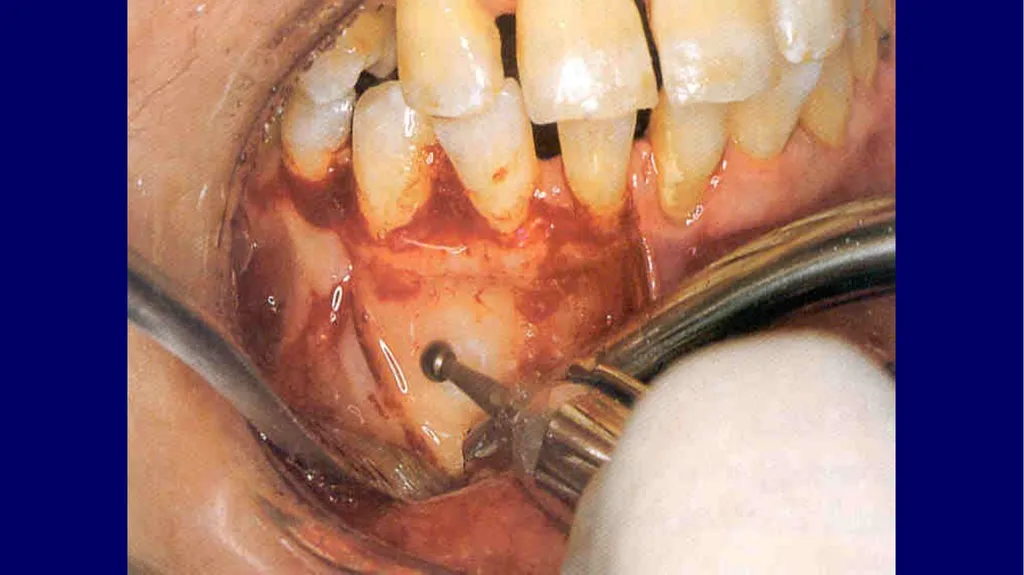 Impacted canines • Maxillary canines more commonly - slide 47 of 63