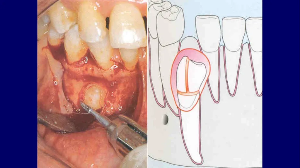 Impacted canines • Maxillary canines more commonly - slide 48 of 63