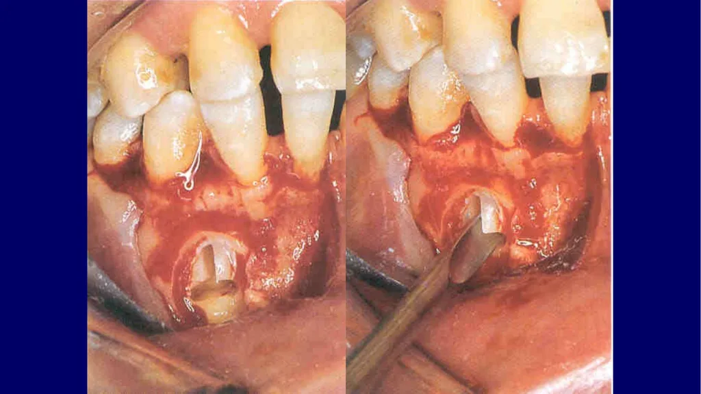 Impacted canines • Maxillary canines more commonly - slide 49 of 63