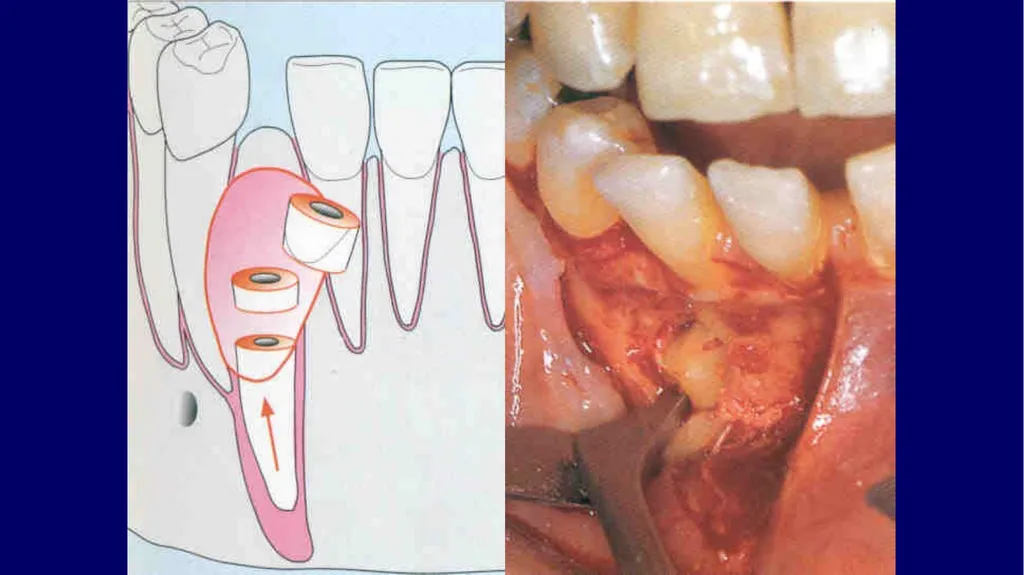 Impacted canines • Maxillary canines more commonly - slide 50 of 63