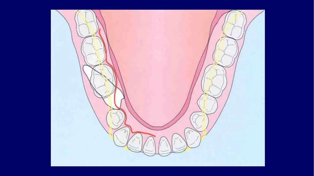Impacted canines • Maxillary canines more commonly - slide 51 of 63