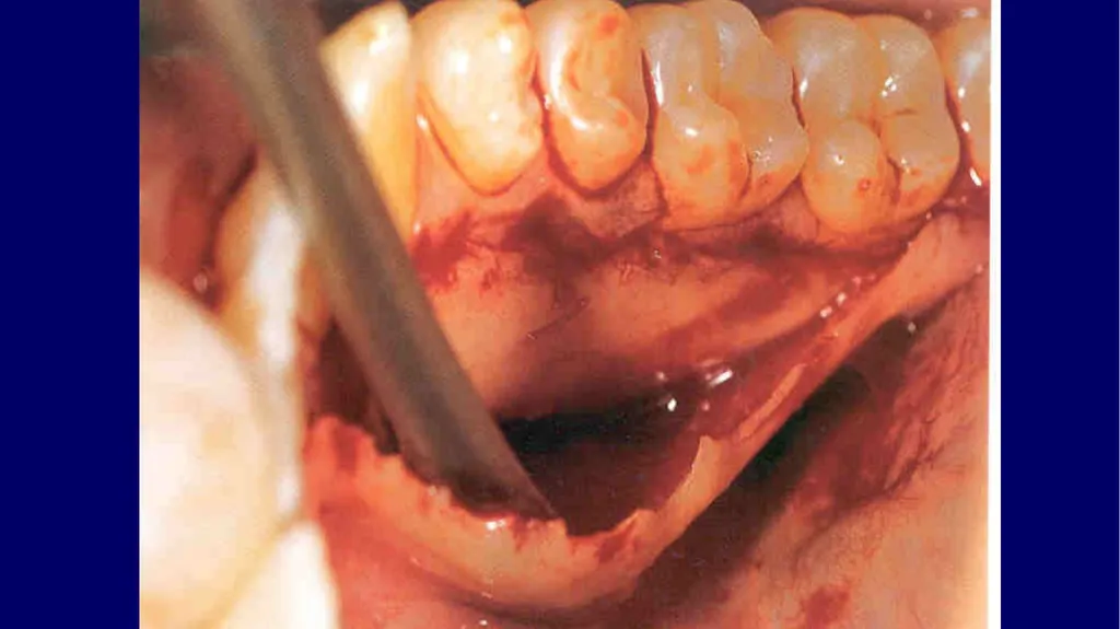 Impacted canines • Maxillary canines more commonly - slide 52 of 63