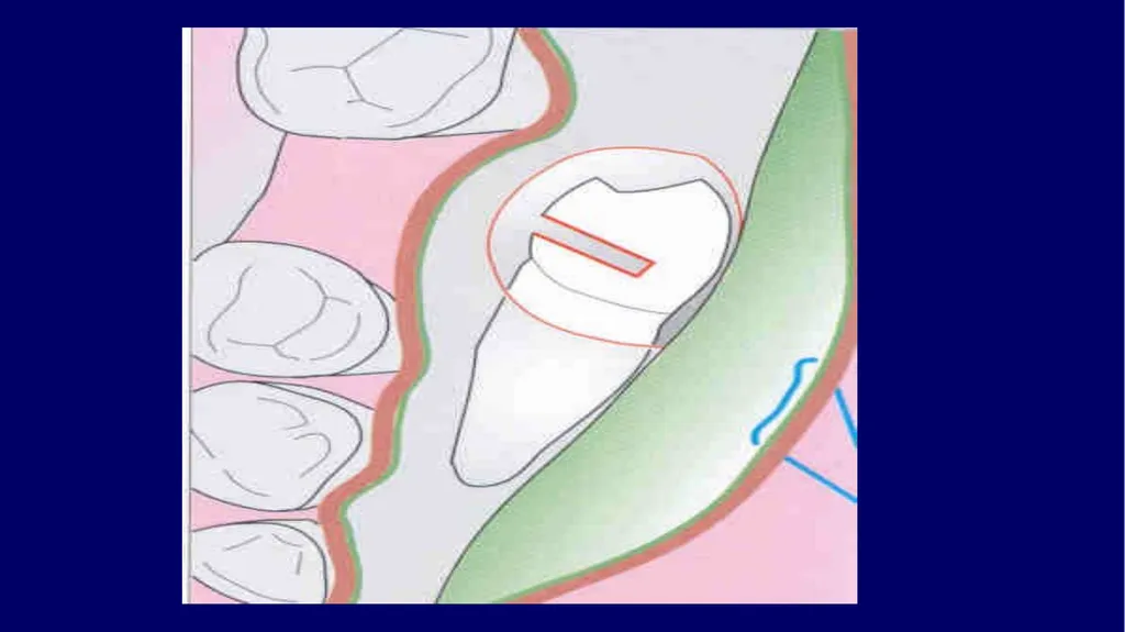 Impacted canines • Maxillary canines more commonly - slide 53 of 63