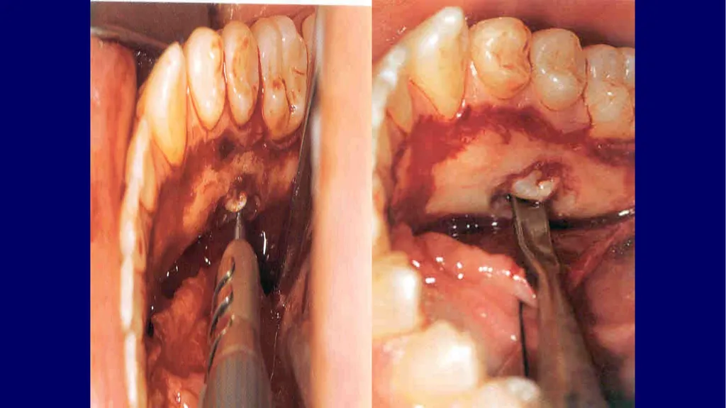 Impacted canines • Maxillary canines more commonly - slide 54 of 63
