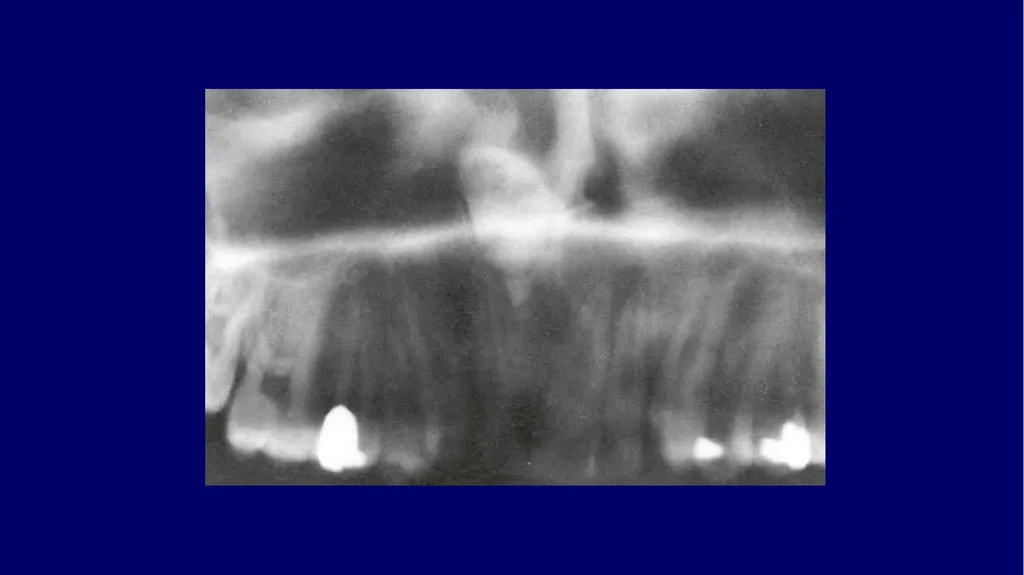 Impacted canines • Maxillary canines more commonly - slide 56 of 63