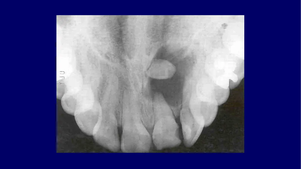 Impacted canines • Maxillary canines more commonly - slide 57 of 63