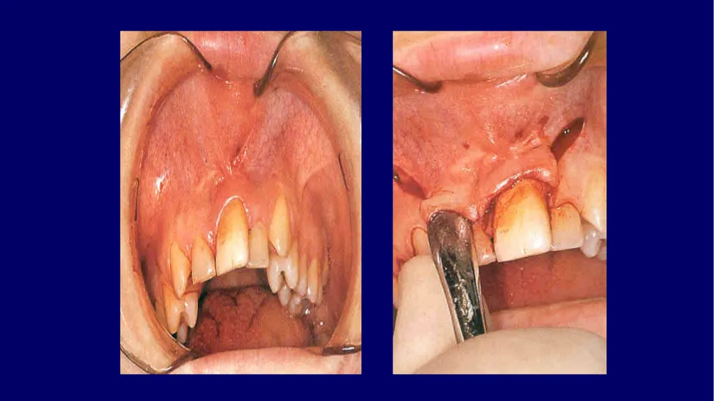 Impacted canines • Maxillary canines more commonly - slide 58 of 63