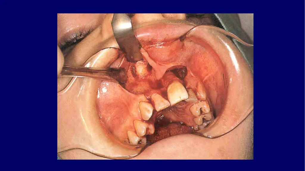 Impacted canines • Maxillary canines more commonly - slide 59 of 63