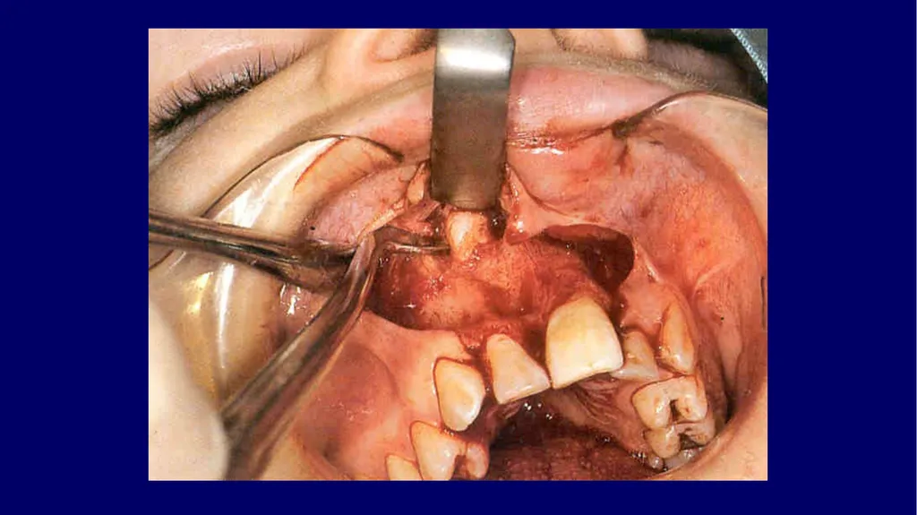 Impacted canines • Maxillary canines more commonly - slide 60 of 63
