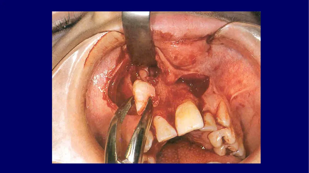 Impacted canines • Maxillary canines more commonly - slide 61 of 63