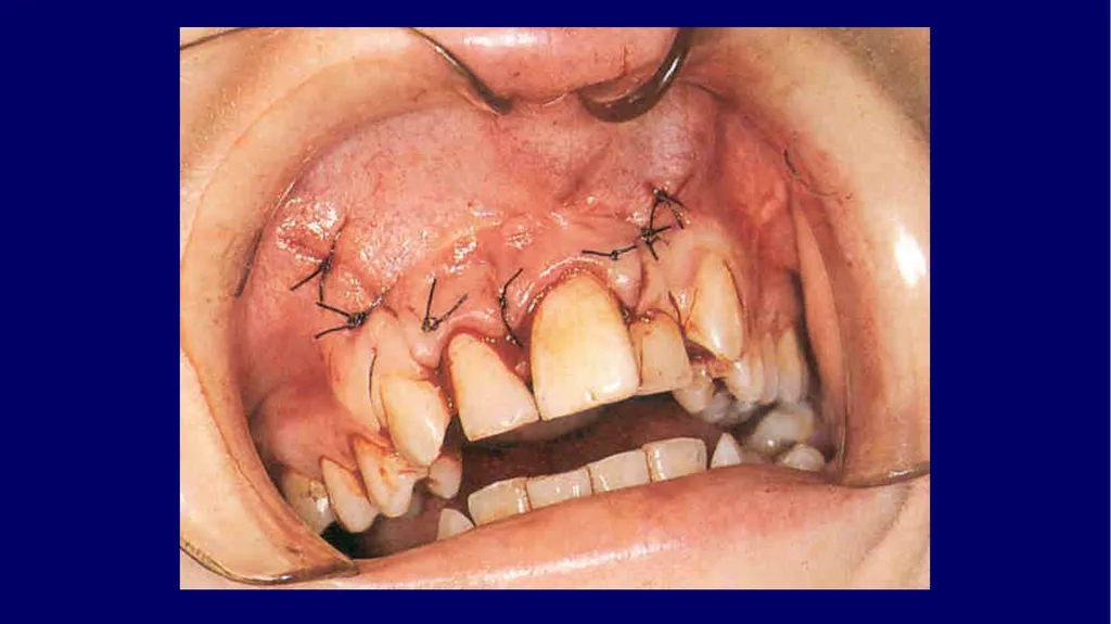 Impacted canines • Maxillary canines more commonly - slide 62 of 63