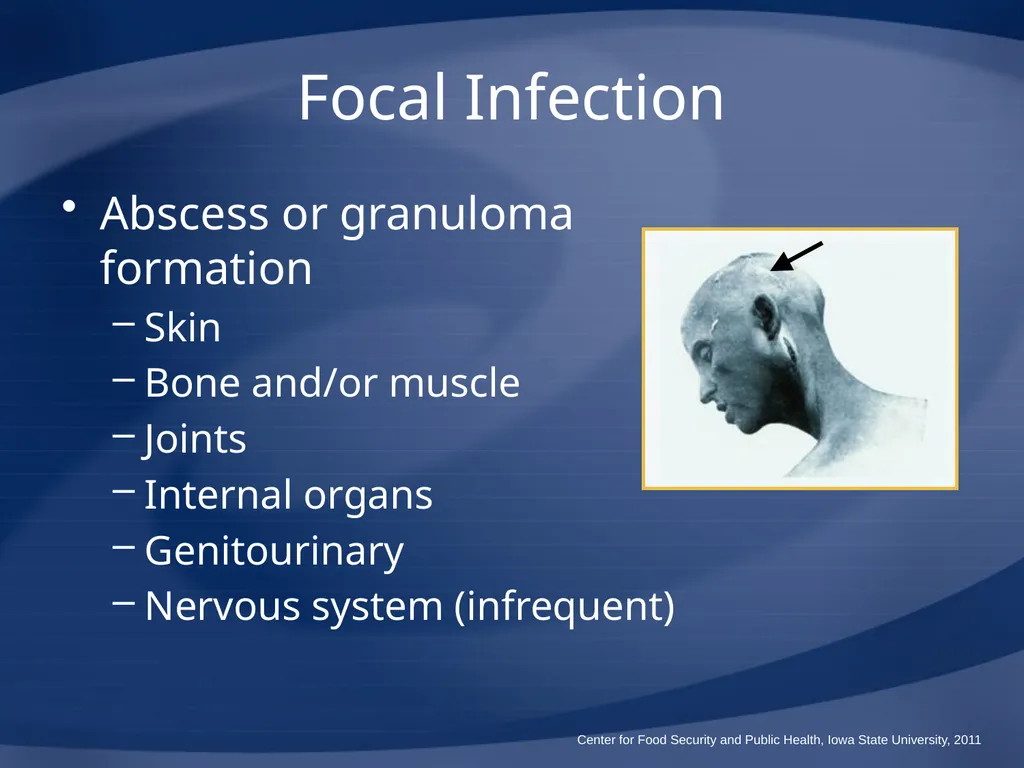 Melioidosis Pseudoglanders Whitmore Disease - slide 19 of 31