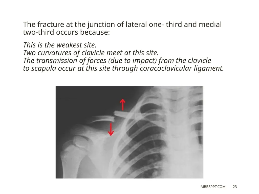 The clavicle (collar bone) BY MBBSPPT.COM The - slide 23 of 26