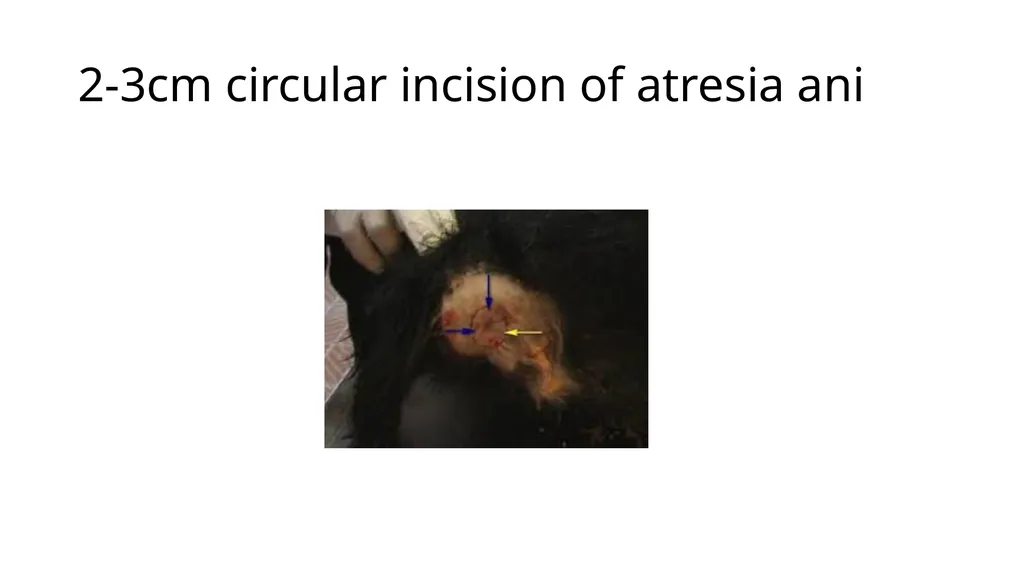 UNIT-5 (REGIONAL SURGERY-II) Rectal prolapse, - slide 31 of 34