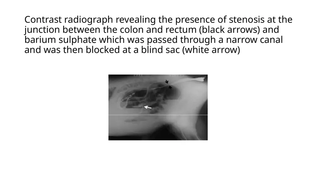 UNIT-5 (REGIONAL SURGERY-II) Rectal prolapse, - slide 24 of 34