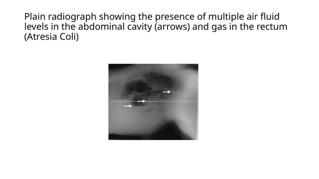 UNIT-5 (REGIONAL SURGERY-II) Rectal prolapse, - slide 18 of 34