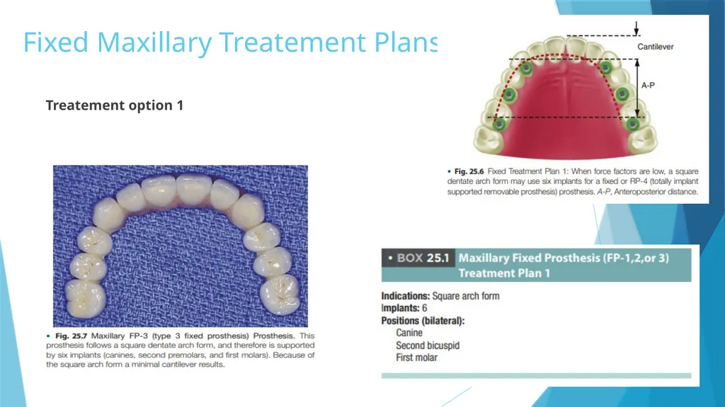 Prosthetic Options in Implant Dentistry Guided By - slide 47 of 53