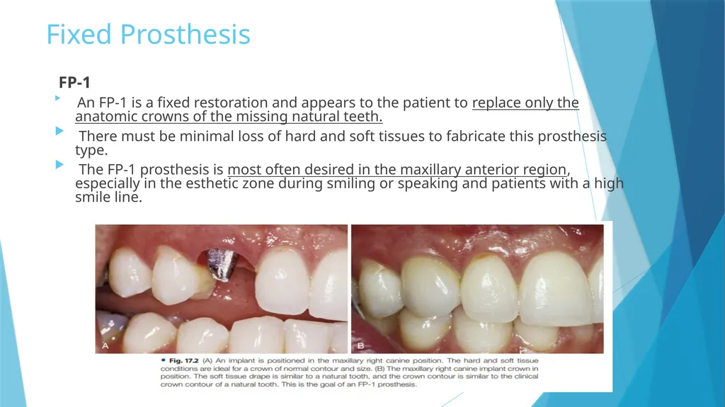 Prosthetic Options in Implant Dentistry Guided By - slide 5 of 53