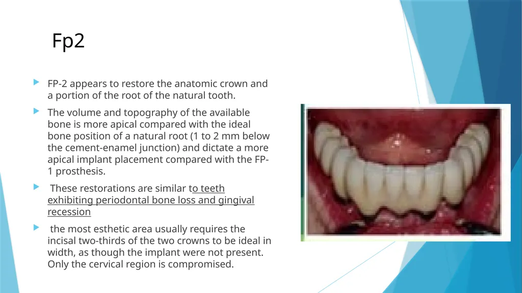 Prosthetic Options in Implant Dentistry Guided By - slide 7 of 53