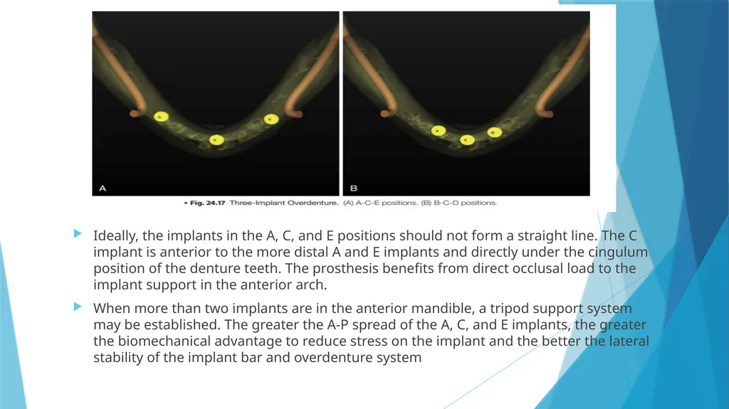 Prosthetic Options in Implant Dentistry Guided By - slide 27 of 53