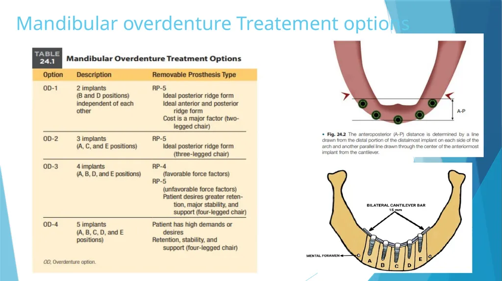 Prosthetic Options in Implant Dentistry Guided By - slide 22 of 53