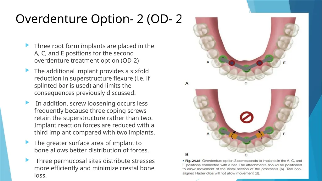 Prosthetic Options in Implant Dentistry Guided By - slide 25 of 53