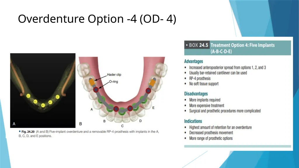 Prosthetic Options in Implant Dentistry Guided By - slide 31 of 53