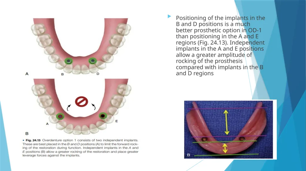 Prosthetic Options in Implant Dentistry Guided By - slide 24 of 53