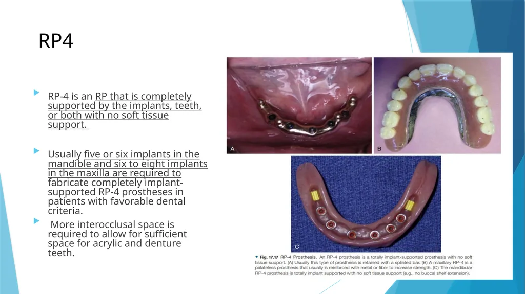 Prosthetic Options in Implant Dentistry Guided By - slide 18 of 53