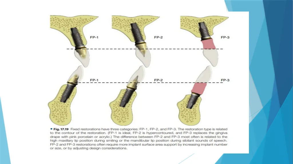 Prosthetic Options in Implant Dentistry Guided By - slide 11 of 53
