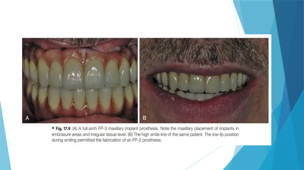 Prosthetic Options in Implant Dentistry Guided By - slide 12 of 53