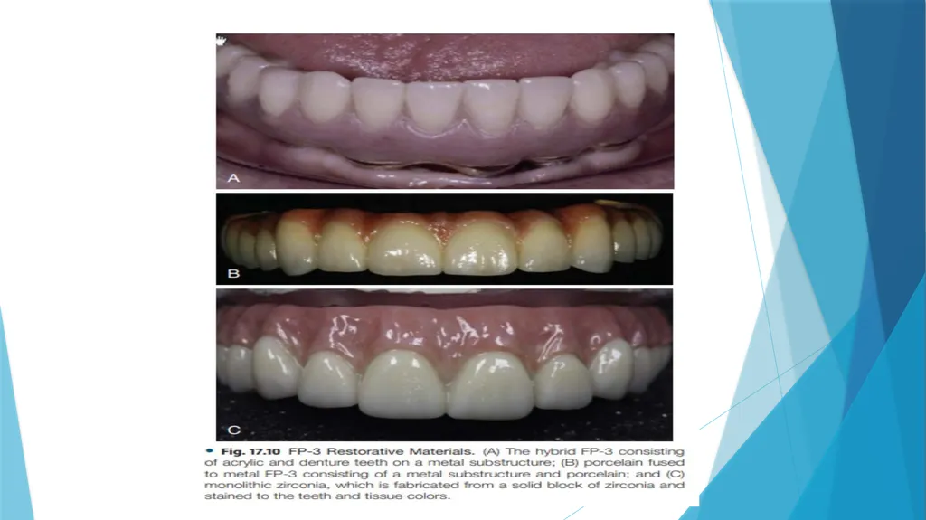 Prosthetic Options in Implant Dentistry Guided By - slide 14 of 53