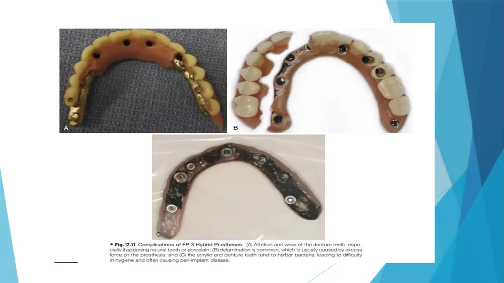Prosthetic Options in Implant Dentistry Guided By - slide 15 of 53
