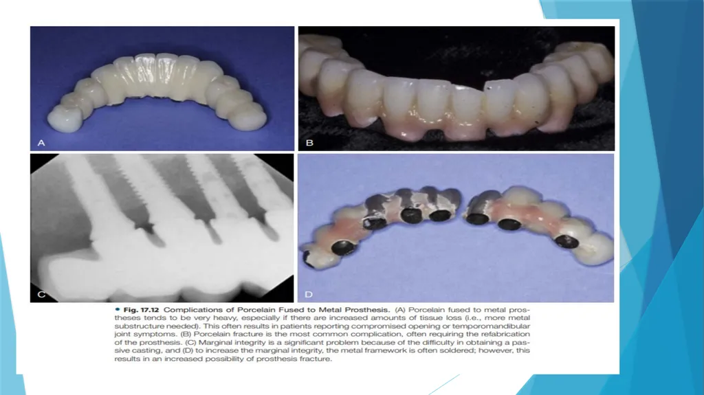 Prosthetic Options in Implant Dentistry Guided By - slide 16 of 53