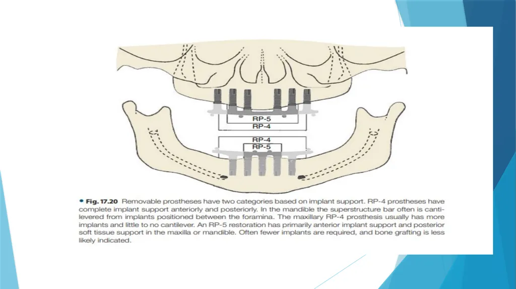 Prosthetic Options in Implant Dentistry Guided By - slide 19 of 53