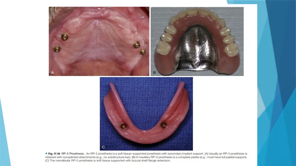 Prosthetic Options in Implant Dentistry Guided By - slide 21 of 53