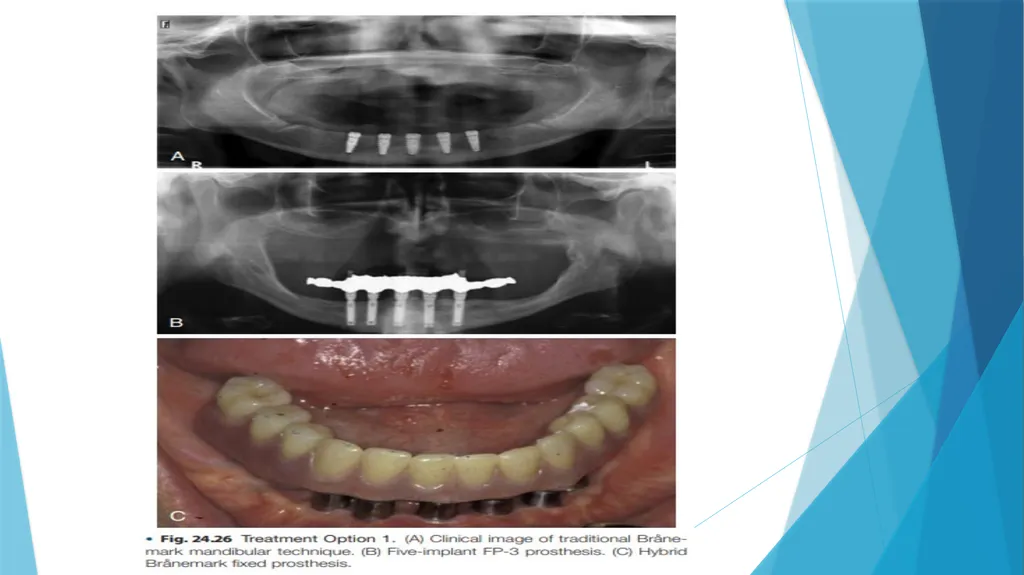 Prosthetic Options in Implant Dentistry Guided By - slide 35 of 53