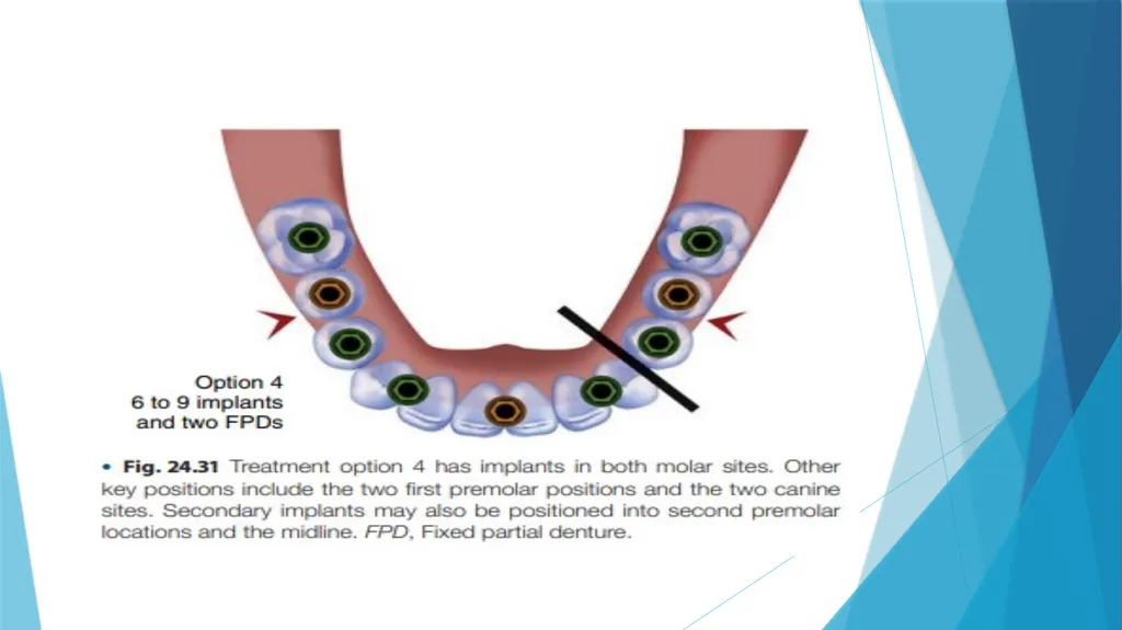 Prosthetic Options in Implant Dentistry Guided By - slide 39 of 53