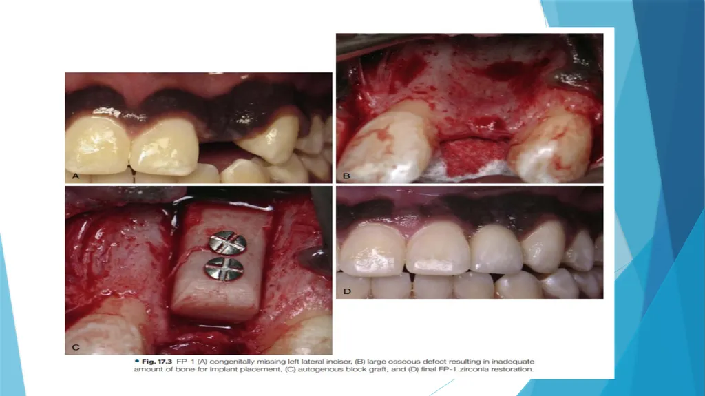 Prosthetic Options in Implant Dentistry Guided By - slide 6 of 53