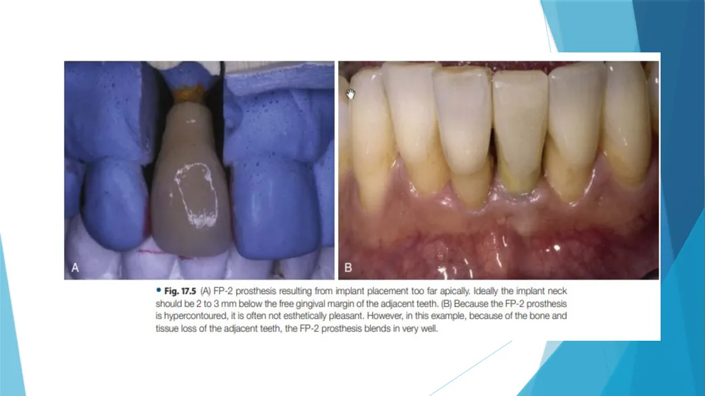 Prosthetic Options in Implant Dentistry Guided By - slide 8 of 53