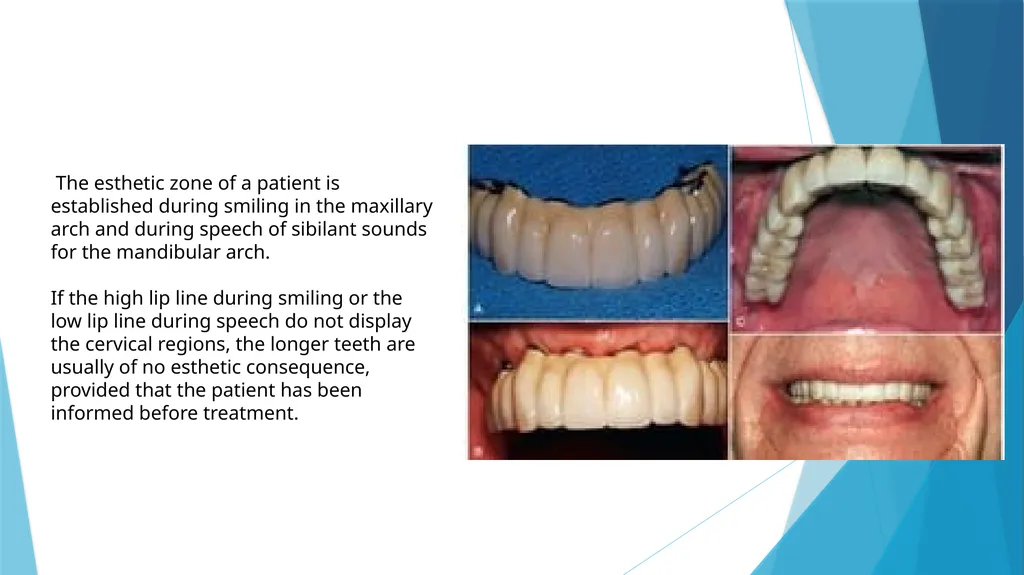 Prosthetic Options in Implant Dentistry Guided By - slide 9 of 53