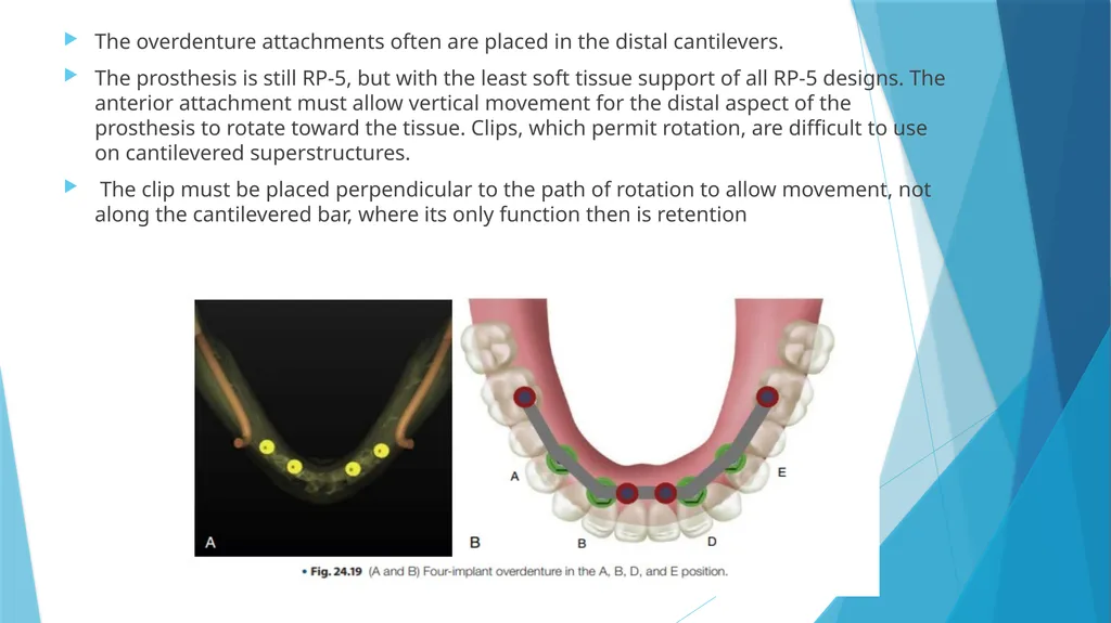 Prosthetic Options in Implant Dentistry Guided By - slide 29 of 53