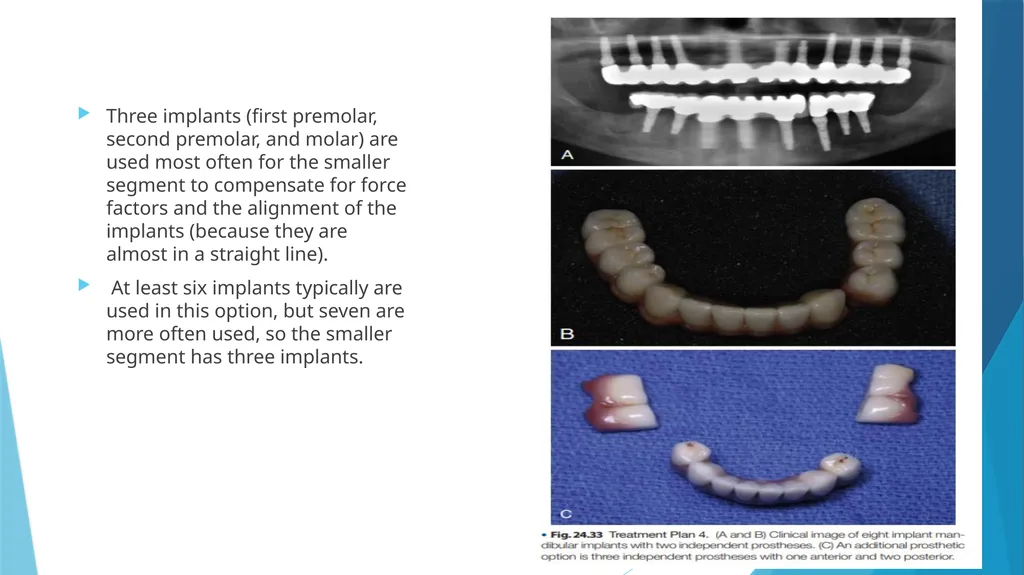 Prosthetic Options in Implant Dentistry Guided By - slide 40 of 53
