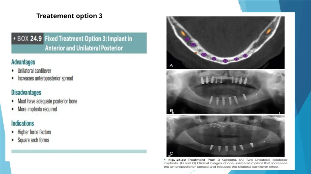 Prosthetic Options in Implant Dentistry Guided By - slide 37 of 53