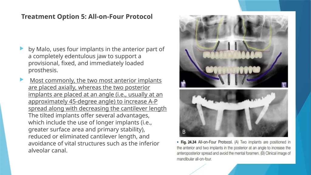 Prosthetic Options in Implant Dentistry Guided By - slide 41 of 53