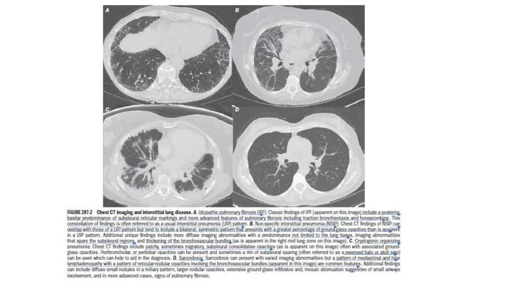 Cryptogenic Organizing Pneumonia Talmadge E. king - slide 10 of 29