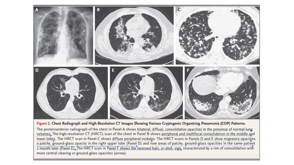 Cryptogenic Organizing Pneumonia Talmadge E. king - slide 17 of 29