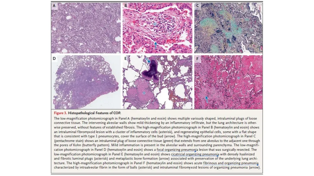 Cryptogenic Organizing Pneumonia Talmadge E. king - slide 21 of 29