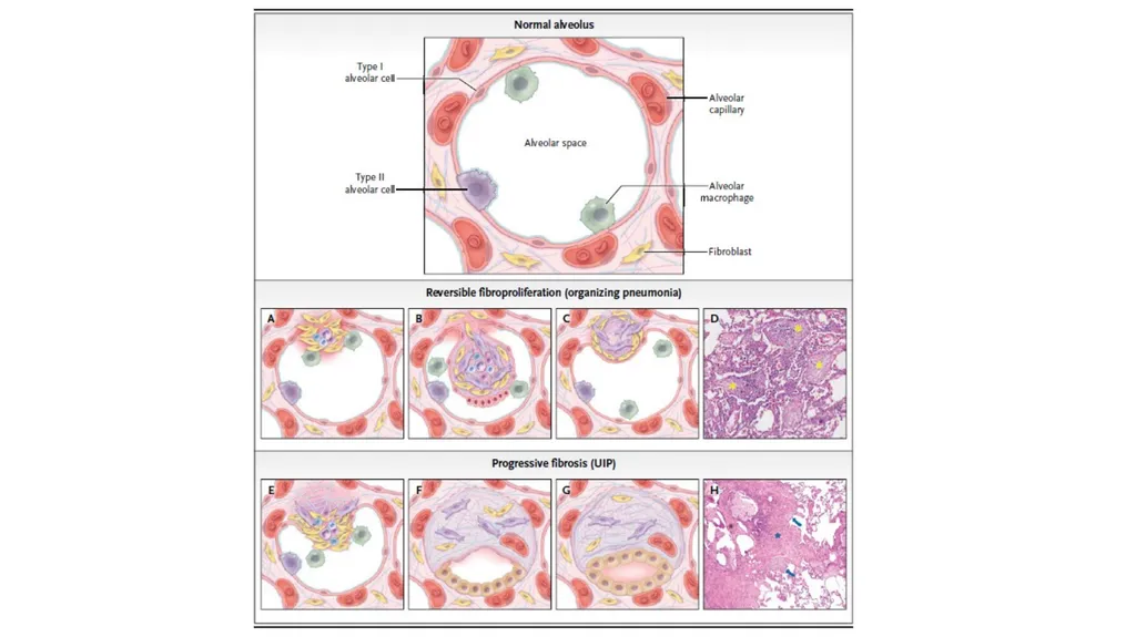 Cryptogenic Organizing Pneumonia Talmadge E. king - slide 8 of 29