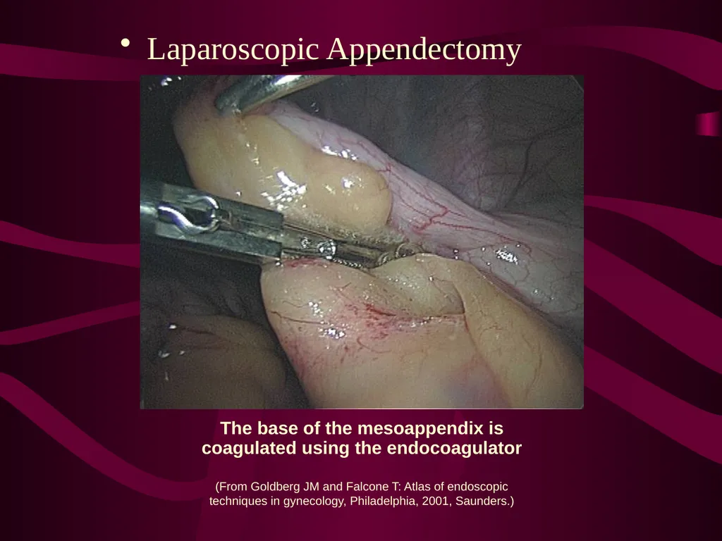 SUR 111 Tracheotomy/Tracheostomy Appendectomy - slide 22 of 28